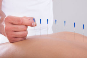 flying needle oriental medicine offers safe virtually painless acupuncture treatment