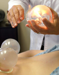 acupuncturists preparing glass cups for chinese cupping therapy