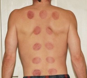 chinese cupping therapy suction cup marks