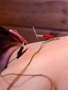 flying needle oriental medicine offers electro-acupuncture or electro-stimulation for enhanced treatment