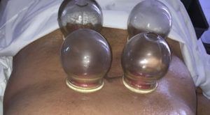 chinese cupping therapy is effective for pain and lung-related conditions