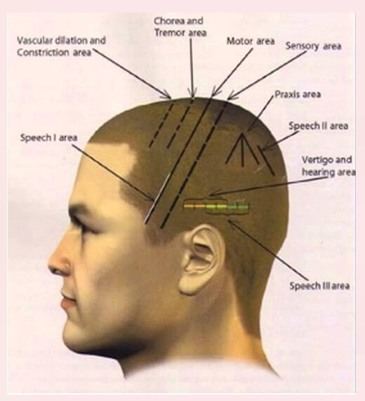 Scalp Acupuncture | Parkinson’s, Brain Injury & Stroke Treatment